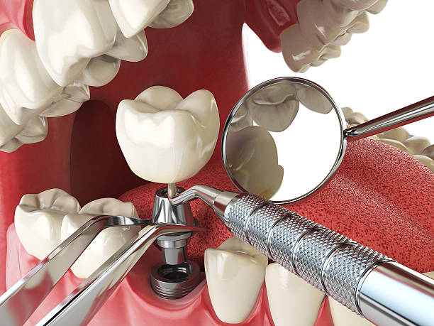 Best Emergency Dentist for Knocked-Out Tooth in Conroe, TX
